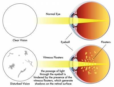 b2ap3_thumbnail_Exeter-eye-vitreous-floaters-vs-normal-eye-diagram.jpg