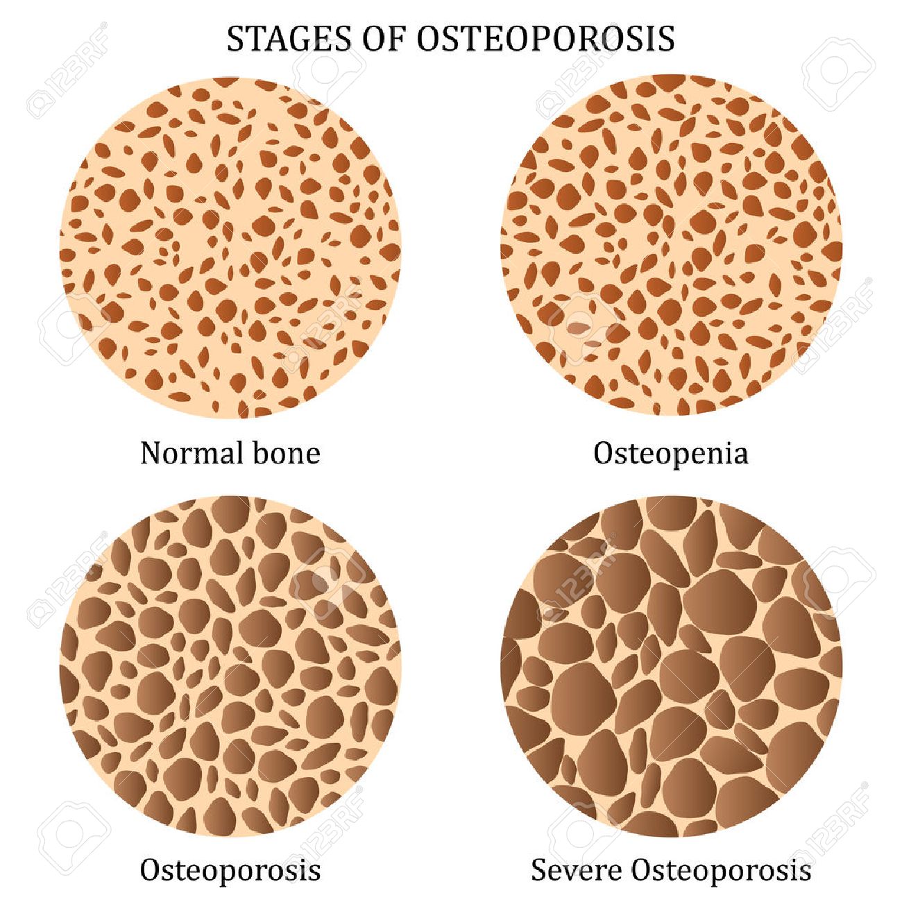 etapas-de-la-osteoporosis-.jpg