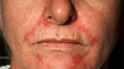 seborrheic-dermatitis-face.jpg